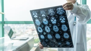 Start working on your case with a traumatic brain injury attorney in Connecticut.